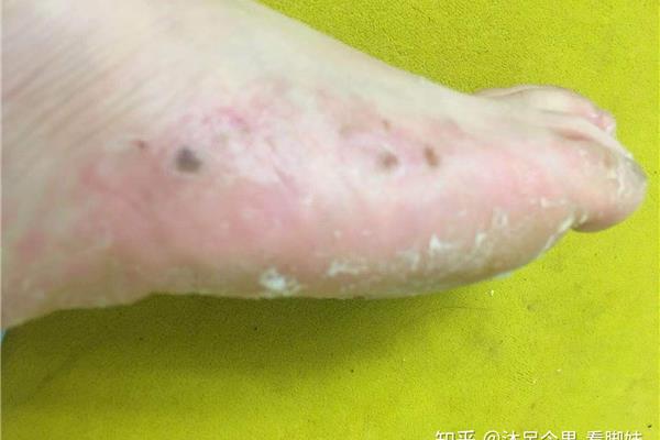 脚背底部的小水泡很痒脚痒起小水泡是什么原因?