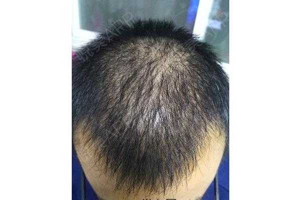 一般长头发要多少钱,发际线植发要多少钱?