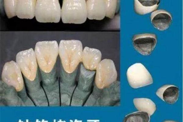 烤瓷牙价格表,镍铬烤瓷牙和钴铬烤瓷牙哪个好?